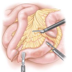 laparoscopic-bowel-resection