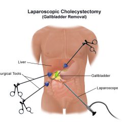 laparoscopic-cholecystectomy