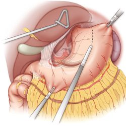 laparoscopic-esophagectomy