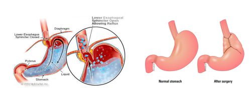 laparoscopic-fundoplication