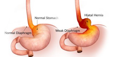 laparoscopic-hernia-repairs