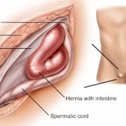 laparoscopic-inguinal-hernia-repair