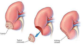 laparoscopic-nephrectomy