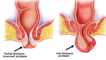 laparoscopic-pelvic-procedures-like-lap-rectopexy