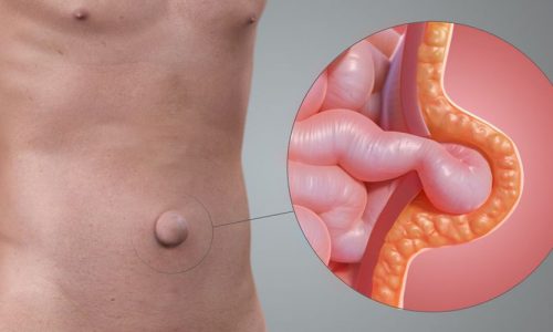 Laparoscopic Surgeries