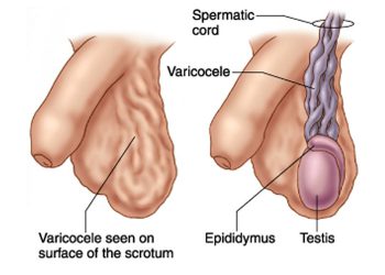 laparoscopic-varicocelectomy