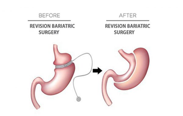revisional-bariatric-surgeries revision-bariatric-surgeries
