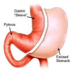 sleeve-gastrectomy sleeve-gastrectomy