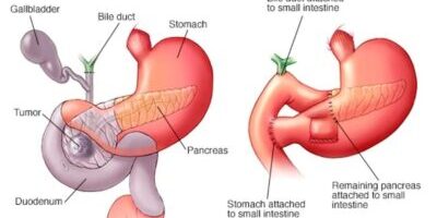 Whipple procedure moin bariatrics